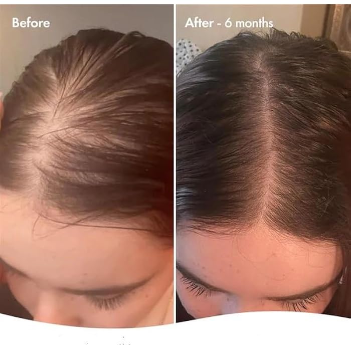 إنفينيتي توب هير لوشن بلس – التركيبة الإسبانية الفعّالة لتساقط الشعروتحفيز النمو – غني بعناصر مقوية من الجذور – 120 مل I من صيدلية الشبراويني - Image 4